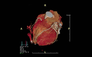 Big data insights on heart disease help millions to live longer, healthier lives
